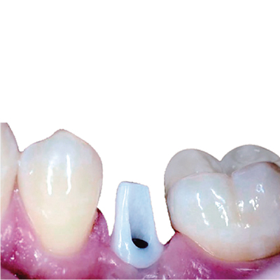 钛Base+氧化锆基台