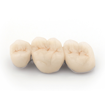 3D打印家红钛合金烤瓷